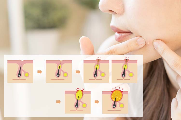 ニキビの原因: 毛穴に皮脂や角質が詰まり、炎症を起こすことでニキビが発生します。