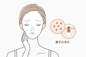 毛穴黒ずみの原因を解説するイラスト