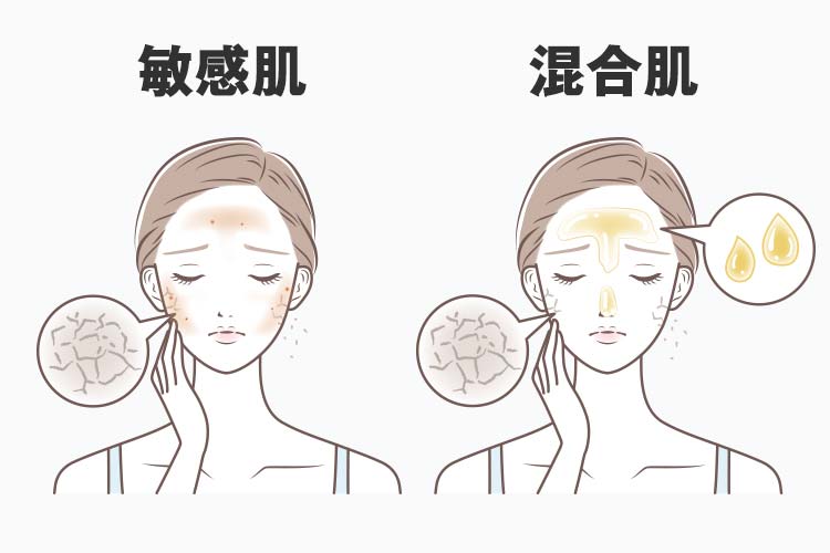 混合肌と敏感肌の特徴