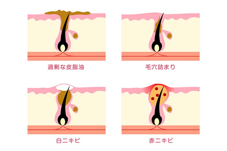ニキビ肌の原因を示すイラスト