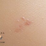 毛穴の黒ずみ・ニキビをケアする洗顔料の効果をイメージしたクローズアップ写真