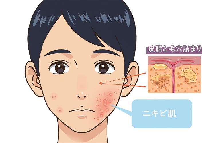 男性ニキビの原因となる皮脂と毛穴詰まりの図解