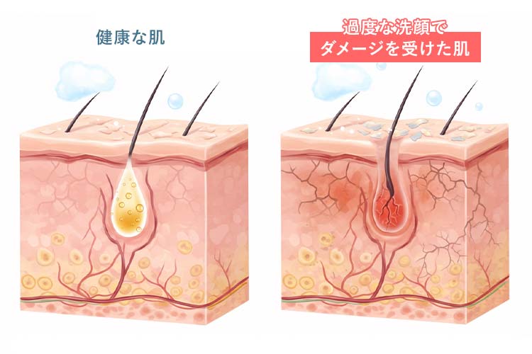 過度な洗顔による肌ダメージのイラスト