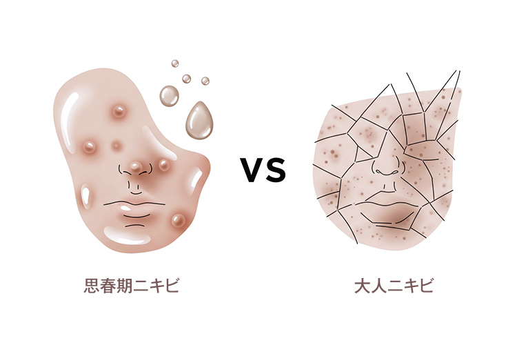 思春期ニキビと大人ニキビの肌タイプ比較