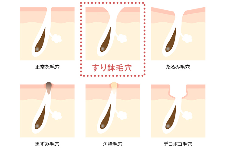 すり鉢毛穴とさまざまな状態の毛穴のイラスト